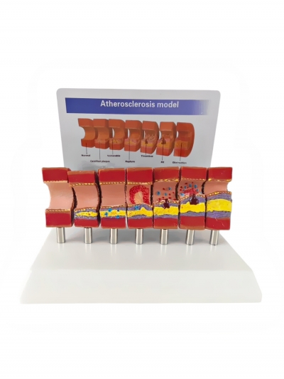 Разборная анатомическая модель атеросклероза сосуда Corpo de Atherosclerosis-1